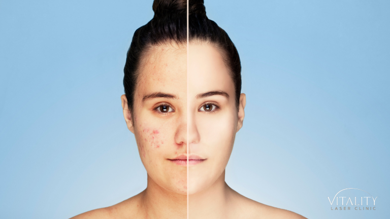 Acne scars and which treatment to use to reduce scarring.