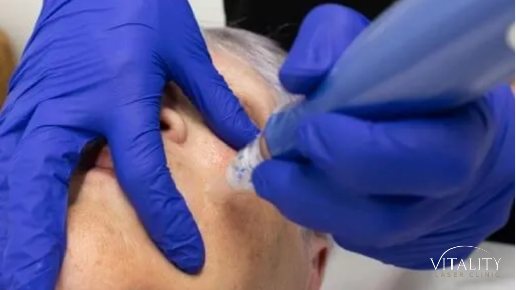 Woman having a microneedling treatment