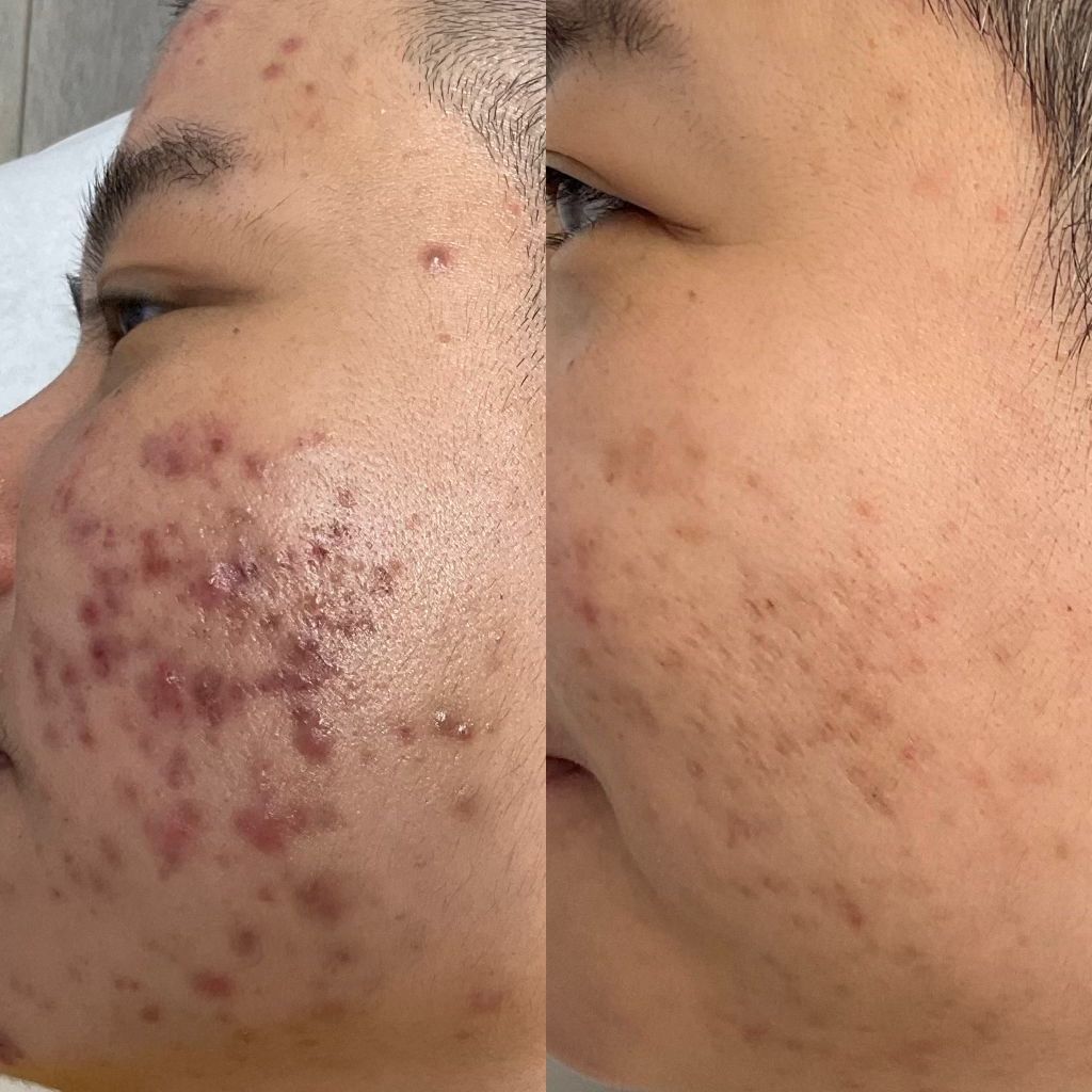Before and After Acne Treatment at Vitality Laser Clinic.