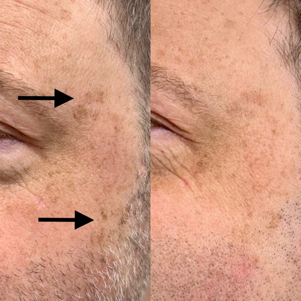 Before and after Alexandrite laser hyperpigmentation treatment on cheeks