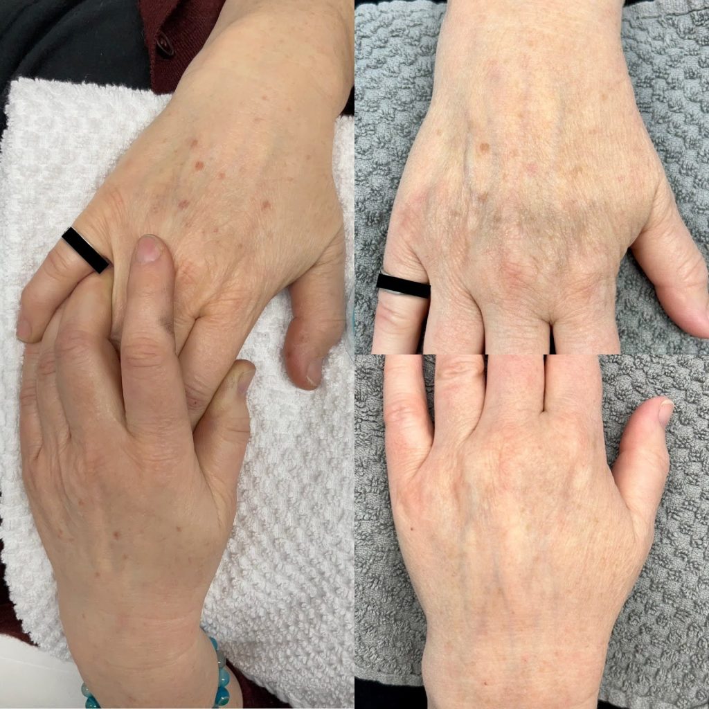 Close-up of melasma (‘pregnancy mask’) fading after treatment