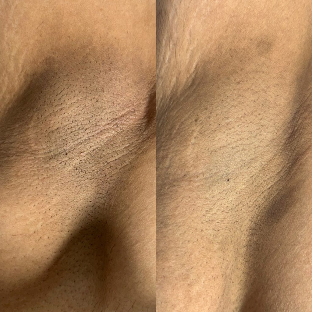 Skin bleaching Victoria BC — professional intimate lightening treatment