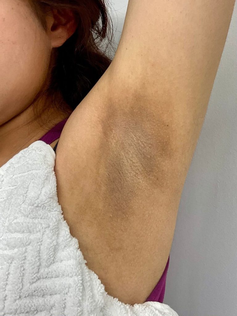 Before and after intimate bleaching results — Vitality Laser Clinic