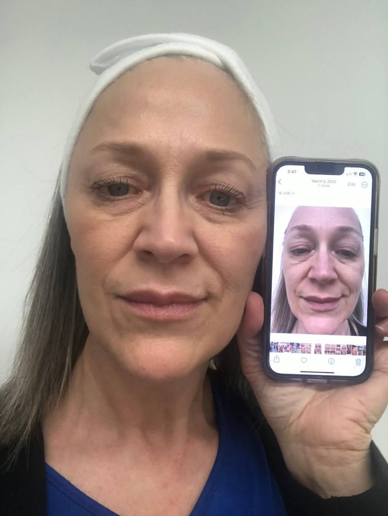 microneedling-and-exosomes-victoria