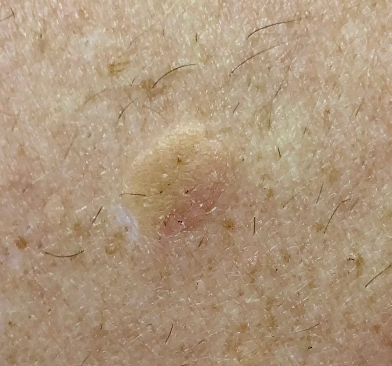 seborrheic keratosis removal Victoria BC