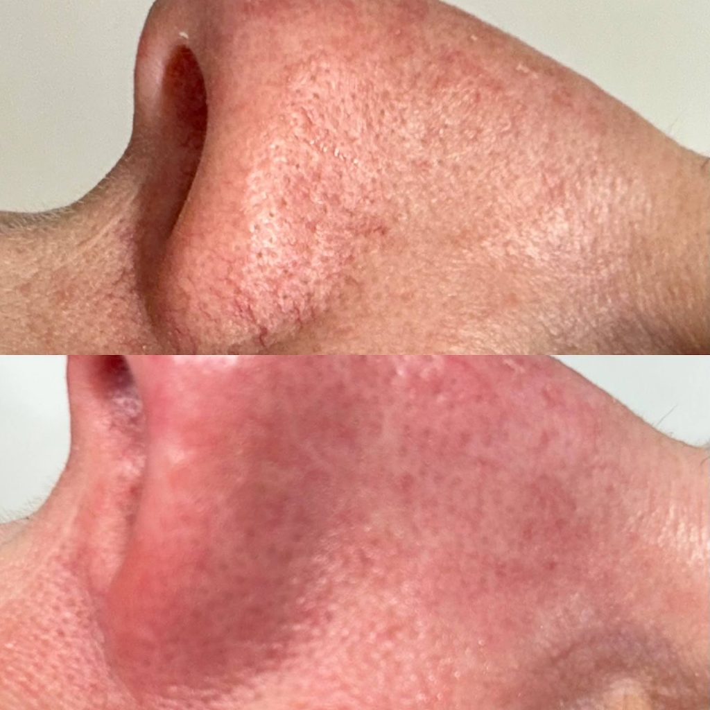 spider-vein-treatment-victoria-bc