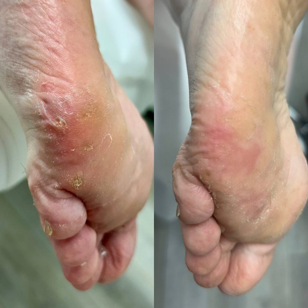 wart removal victoria bc